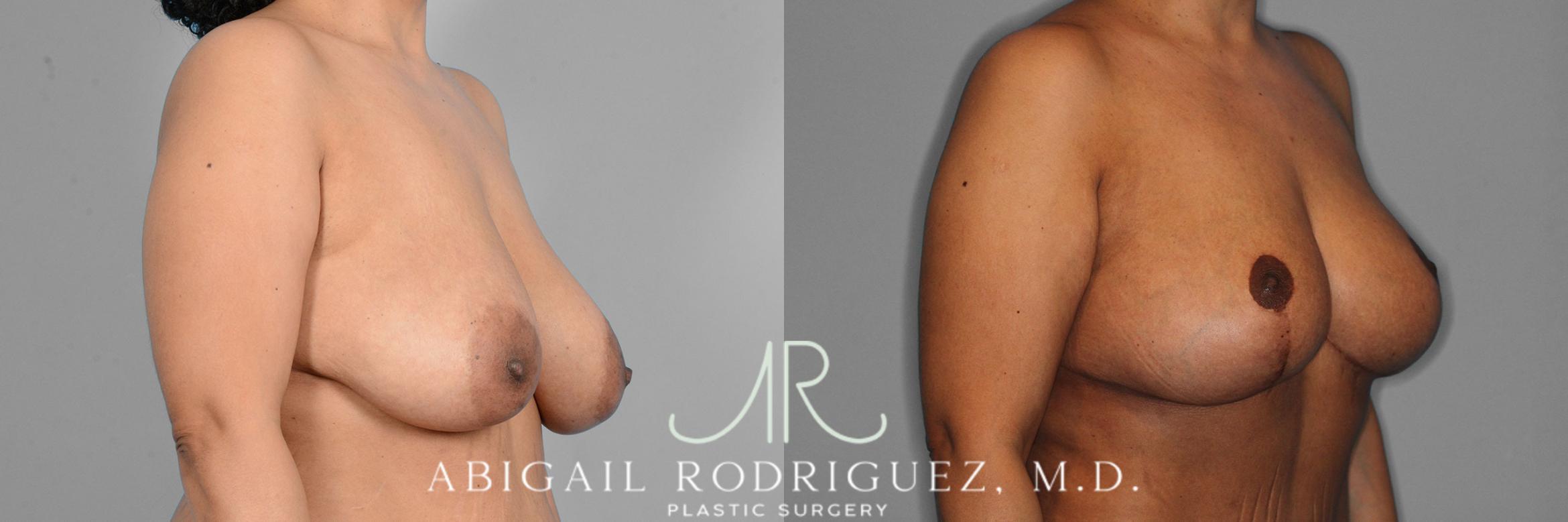 Before & After Breast Lift with Augmentation Case 257421 View 2 View in Houston, TX