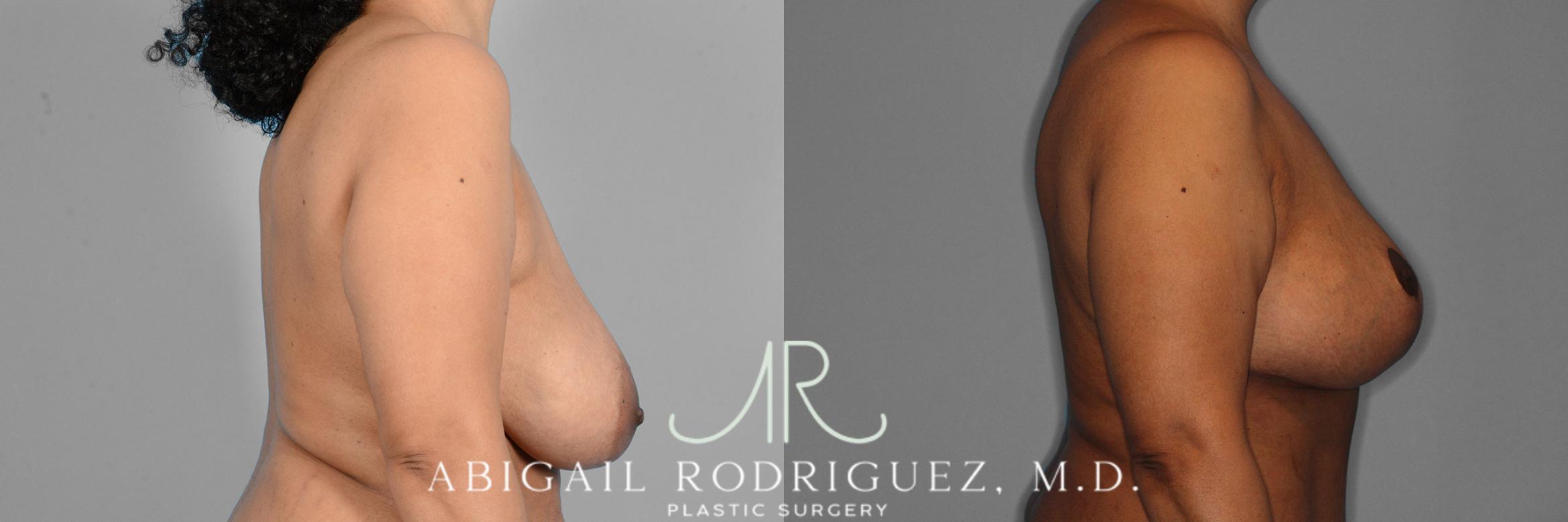 Before & After Breast Lift with Augmentation Case 257421 View 3 View in Houston, TX