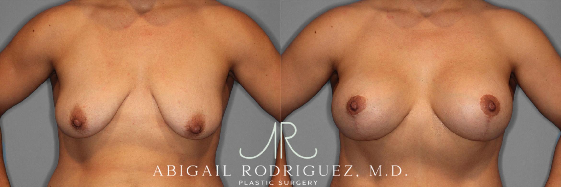 Before & After Breast Lift with Augmentation Case 258201 View 1 View in Houston, TX