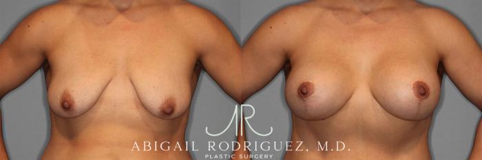 Before & After Breast Lift with Augmentation Case 258201 View 1 View in Houston, TX