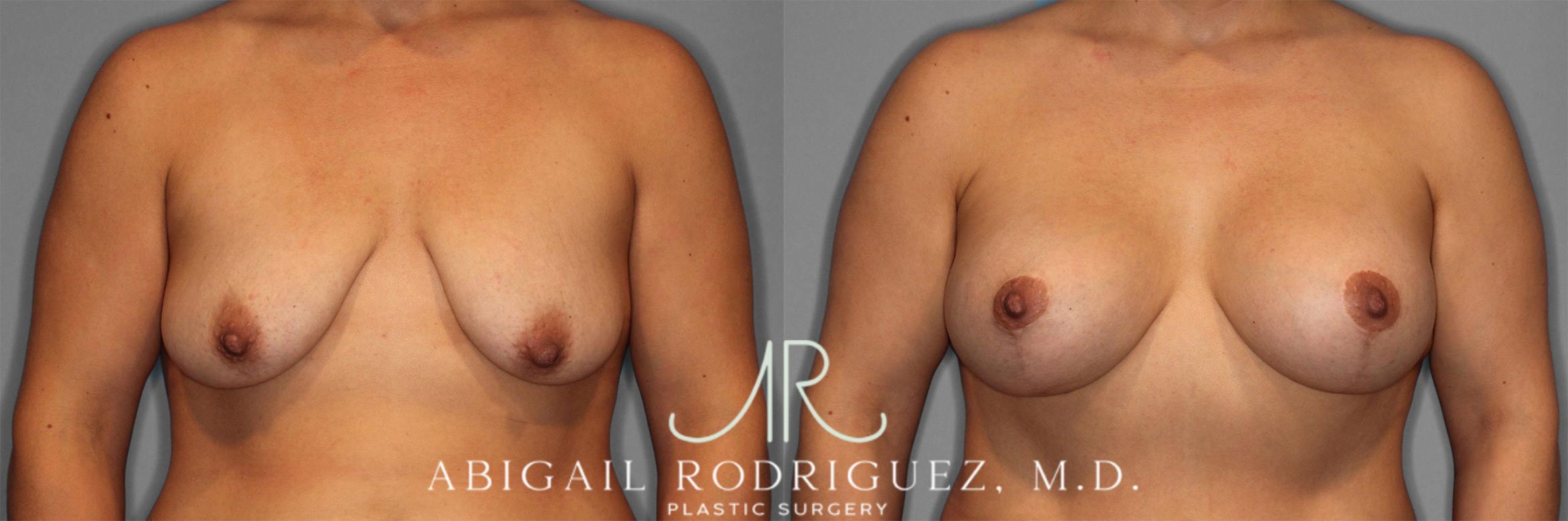 Before & After Breast Lift with Augmentation Case 258201 View 2 View in Houston, TX