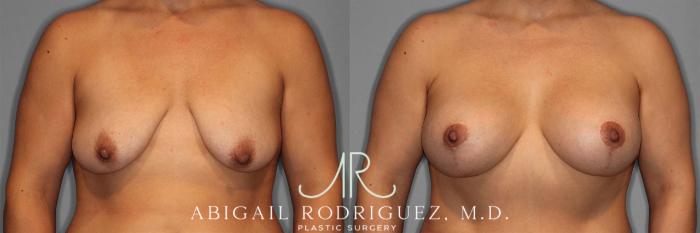 Before & After Breast Lift with Augmentation Case 258201 View 2 View in Houston, TX