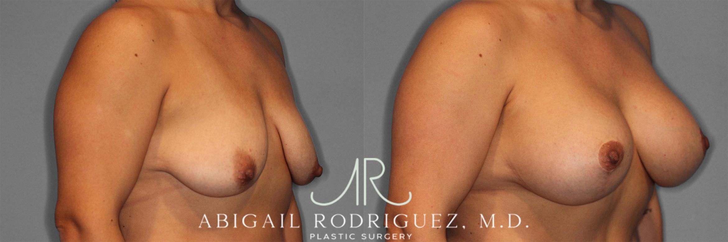 Before & After Breast Lift with Augmentation Case 258201 View 3 View in Houston, TX