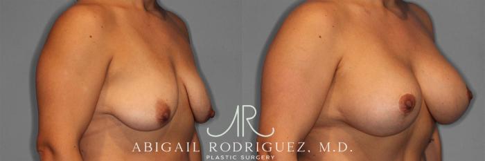 Before & After Breast Lift with Augmentation Case 258201 View 3 View in Houston, TX