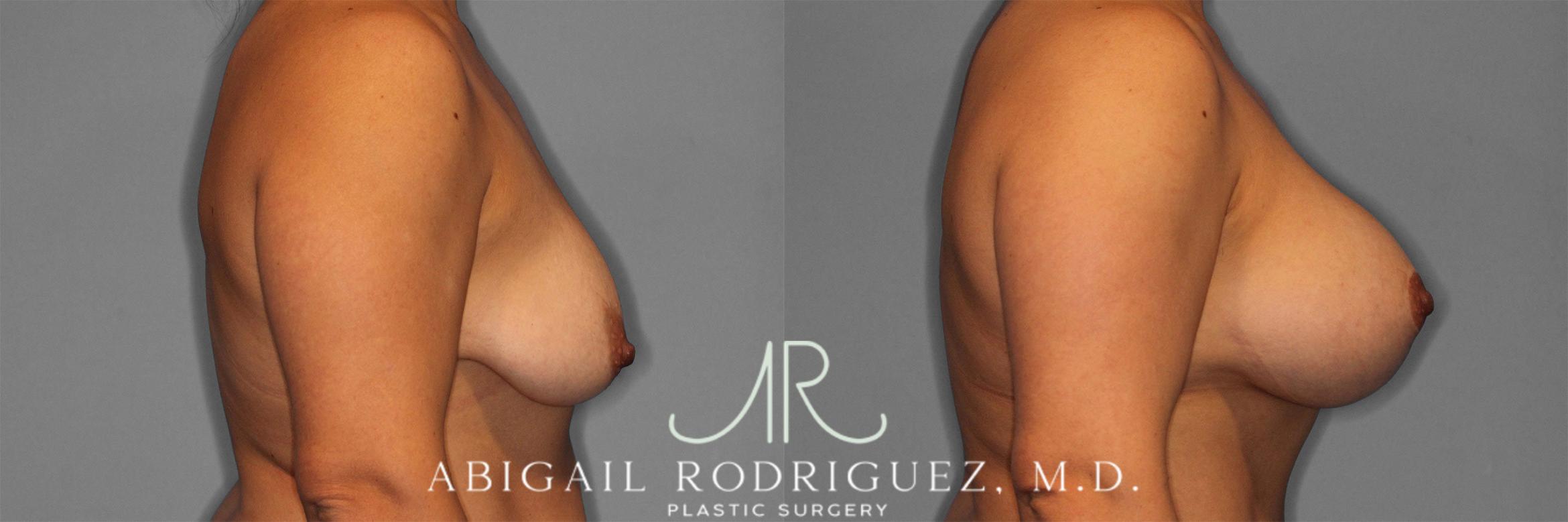 Before & After Breast Lift with Augmentation Case 258201 View 4 View in Houston, TX