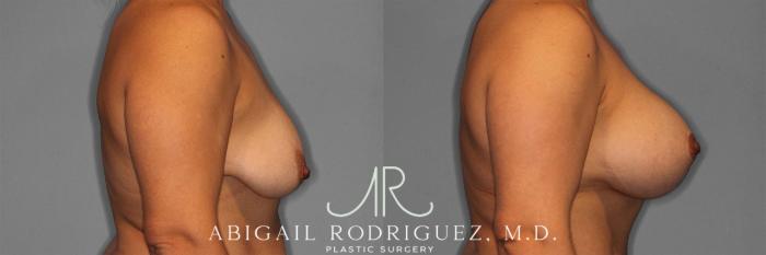 Before & After Breast Lift with Augmentation Case 258201 View 4 View in Houston, TX