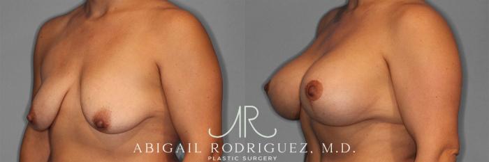 Before & After Breast Lift with Augmentation Case 258201 View 5 View in Houston, TX