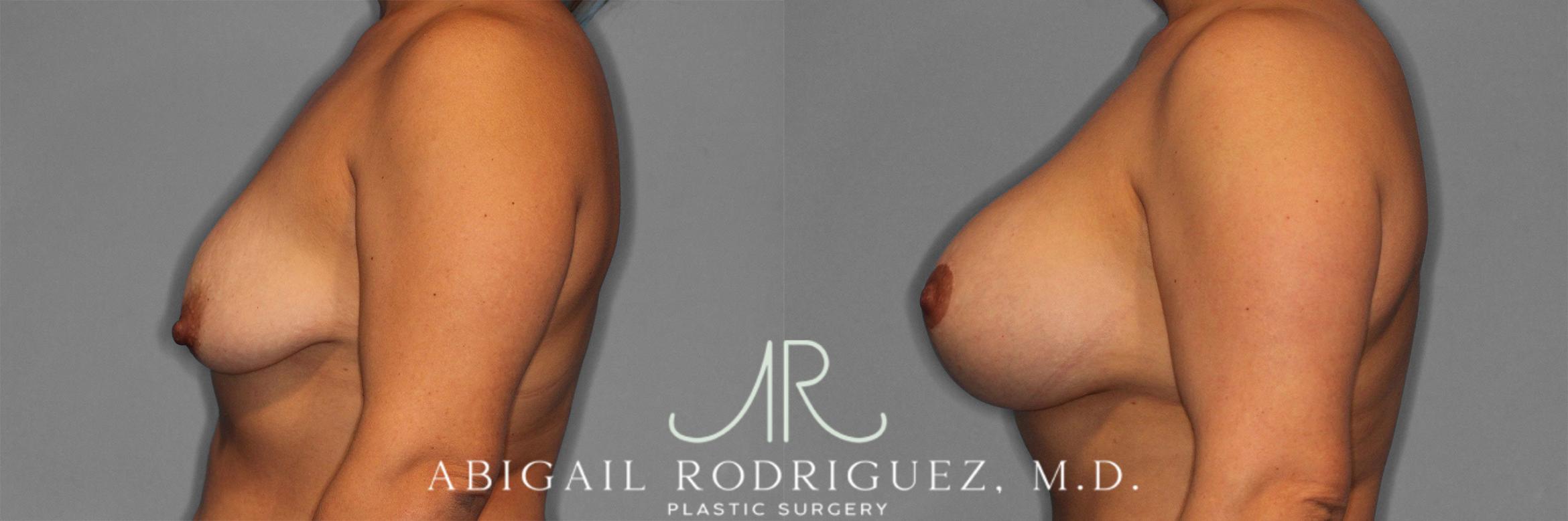 Before & After Breast Lift with Augmentation Case 258201 View 6 View in Houston, TX