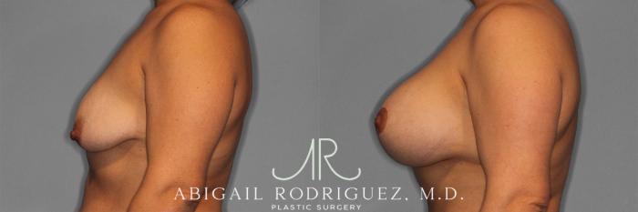 Before & After Breast Lift with Augmentation Case 258201 View 6 View in Houston, TX