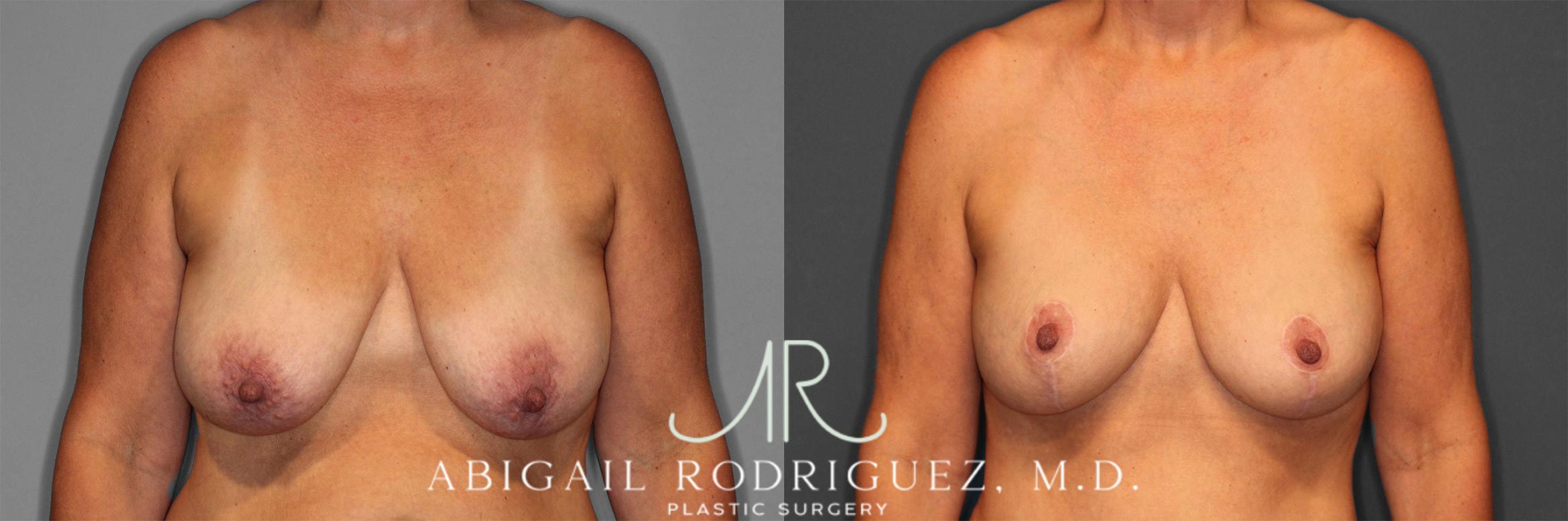 Before & After Breast Lift with Augmentation Case 258258 View 1 View in Houston, TX