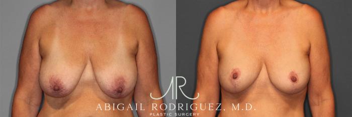 Before & After Breast Lift with Augmentation Case 258258 View 1 View in Houston, TX