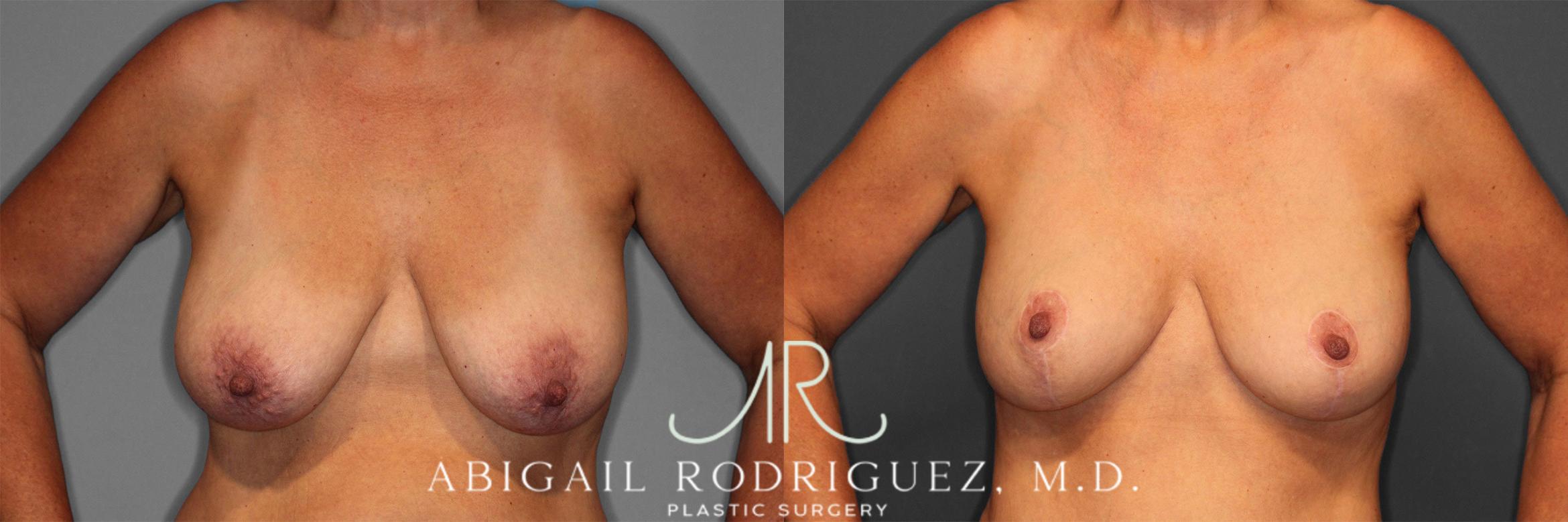 Before & After Breast Lift with Augmentation Case 258258 View 2 View in Houston, TX