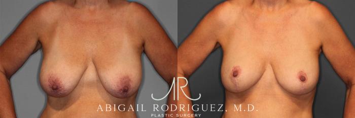 Before & After Breast Lift with Augmentation Case 258258 View 2 View in Houston, TX