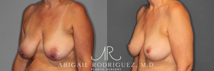 Before & After Breast Lift with Augmentation Case 258258 View 3 View in Houston, TX