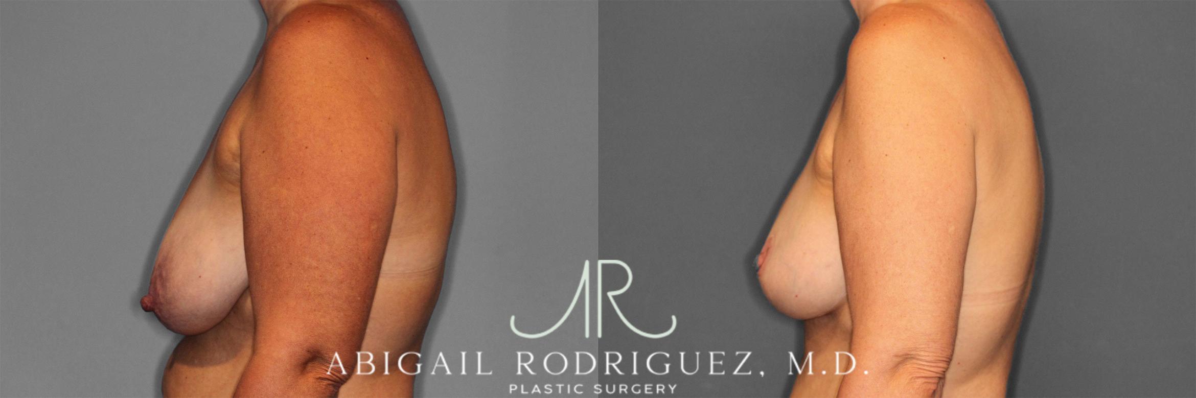 Before & After Breast Lift with Augmentation Case 258258 View 4 View in Houston, TX