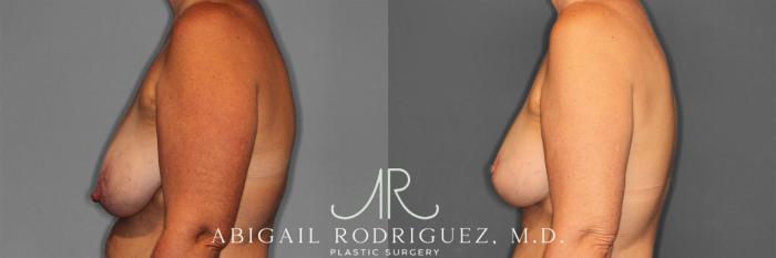 Before & After Breast Lift with Augmentation Case 258258 View 4 View in Houston, TX