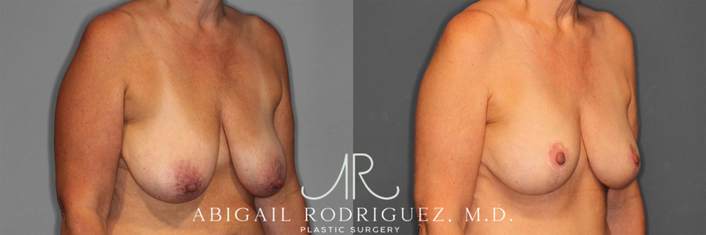 Before & After Breast Lift with Augmentation Case 258258 View 5 View in Houston, TX