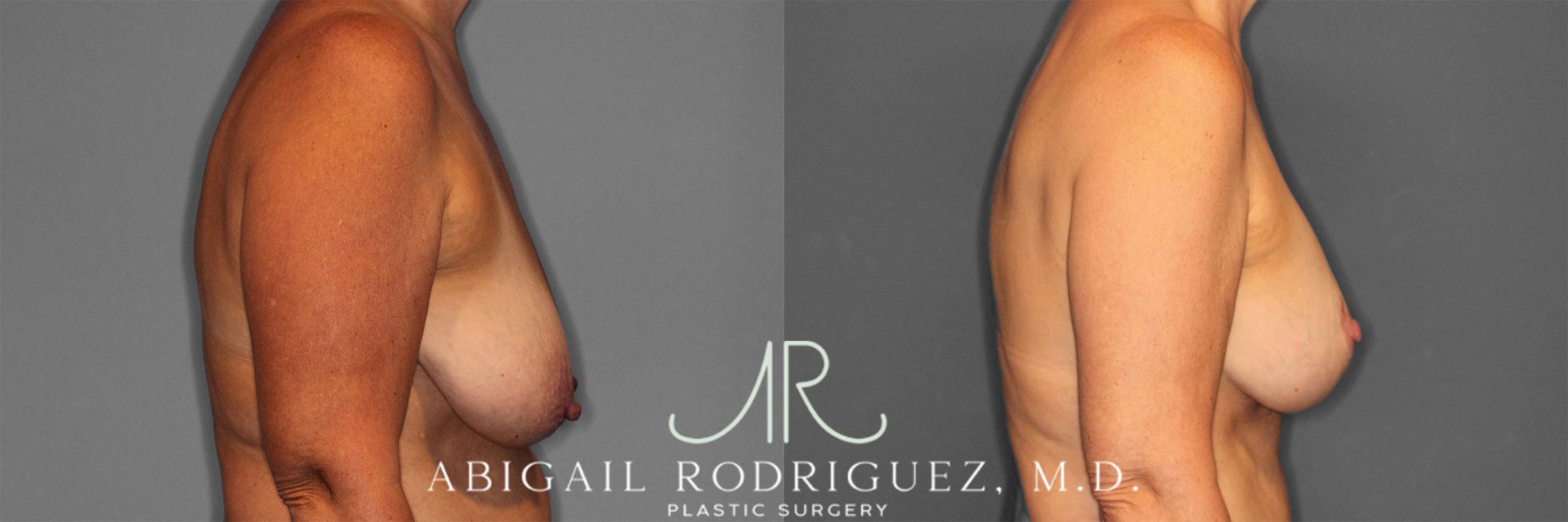 Before & After Breast Lift with Augmentation Case 258258 View 6 View in Houston, TX