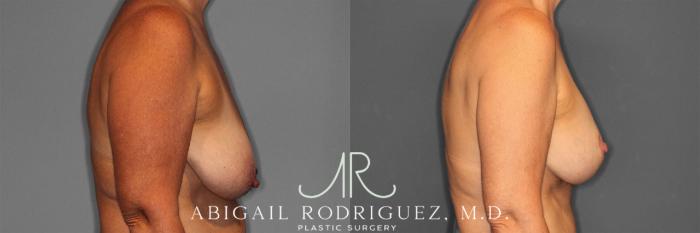 Before & After Breast Lift with Augmentation Case 258258 View 6 View in Houston, TX