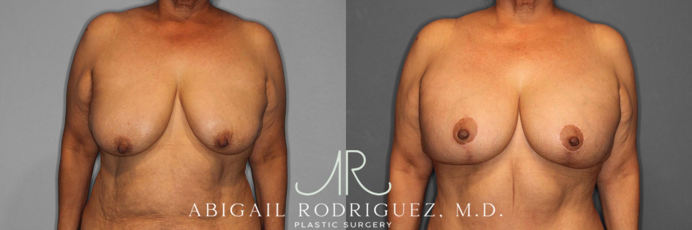 Before & After Breast Lift with Augmentation Case 258488 View 1 View in Houston, TX