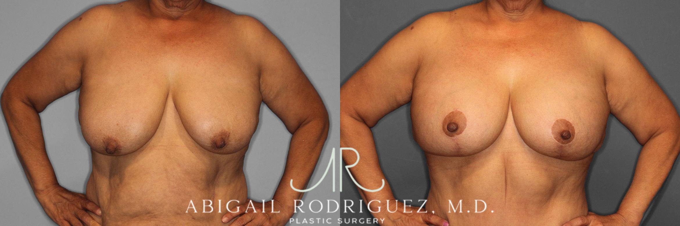 Before & After Breast Lift with Augmentation Case 258488 View 2 View in Houston, TX