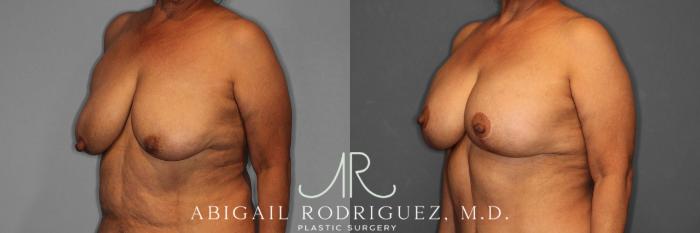 Before & After Breast Lift with Augmentation Case 258488 View 3 View in Houston, TX