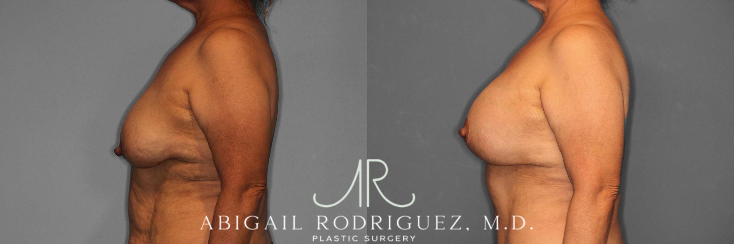 Before & After Breast Lift with Augmentation Case 258488 View 4 View in Houston, TX