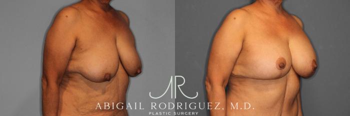 Before & After Breast Lift with Augmentation Case 258488 View 5 View in Houston, TX
