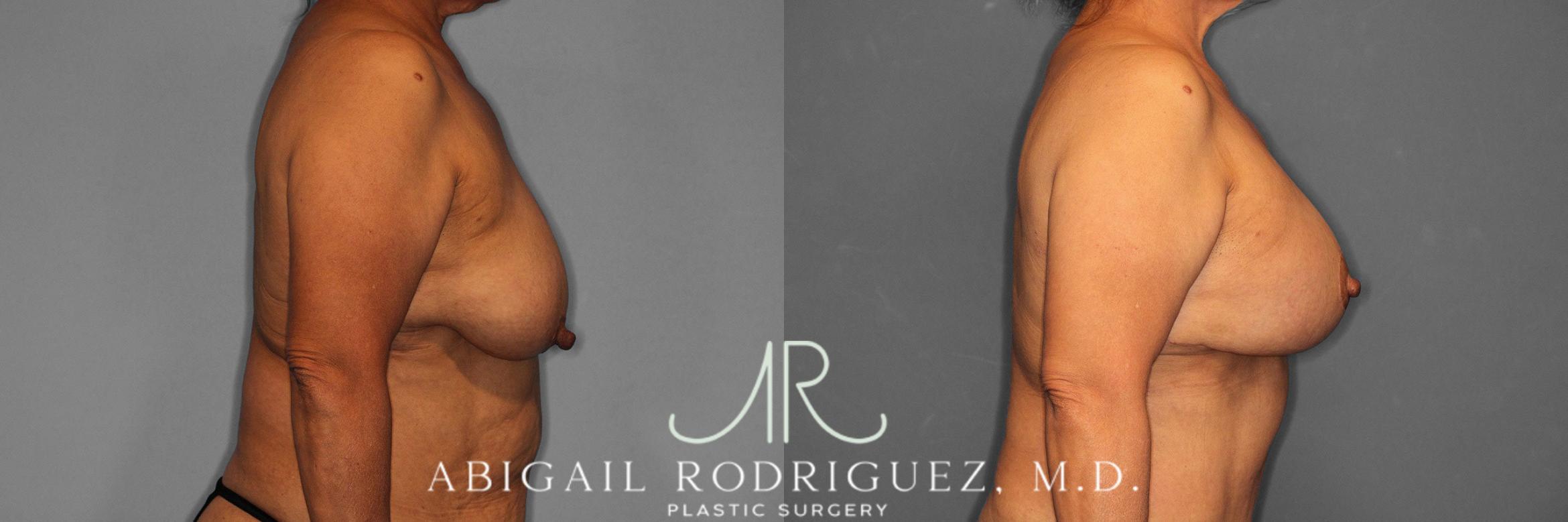 Before & After Breast Lift with Augmentation Case 258488 View 6 View in Houston, TX