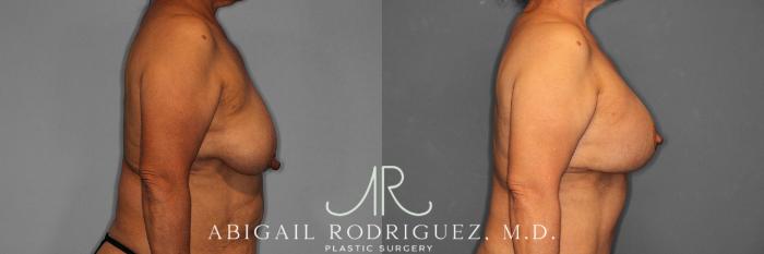Before & After Breast Lift with Augmentation Case 258488 View 6 View in Houston, TX