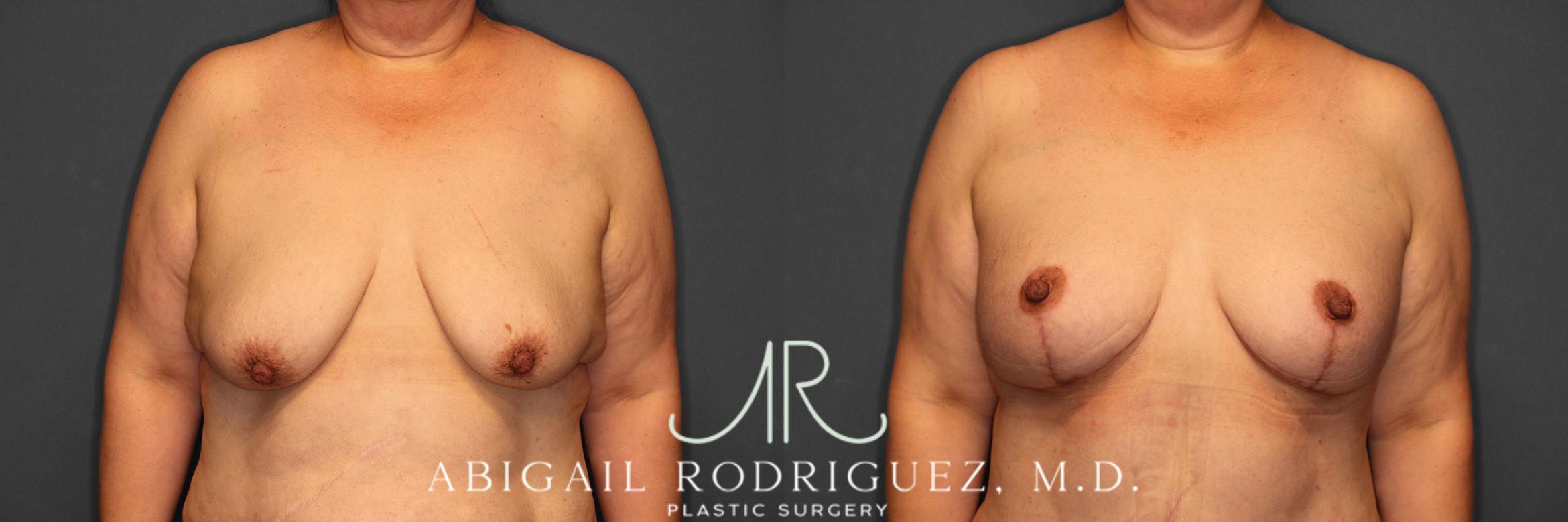 Before & After Breast Lift with Augmentation Case 258530 View 1 View in Houston, TX
