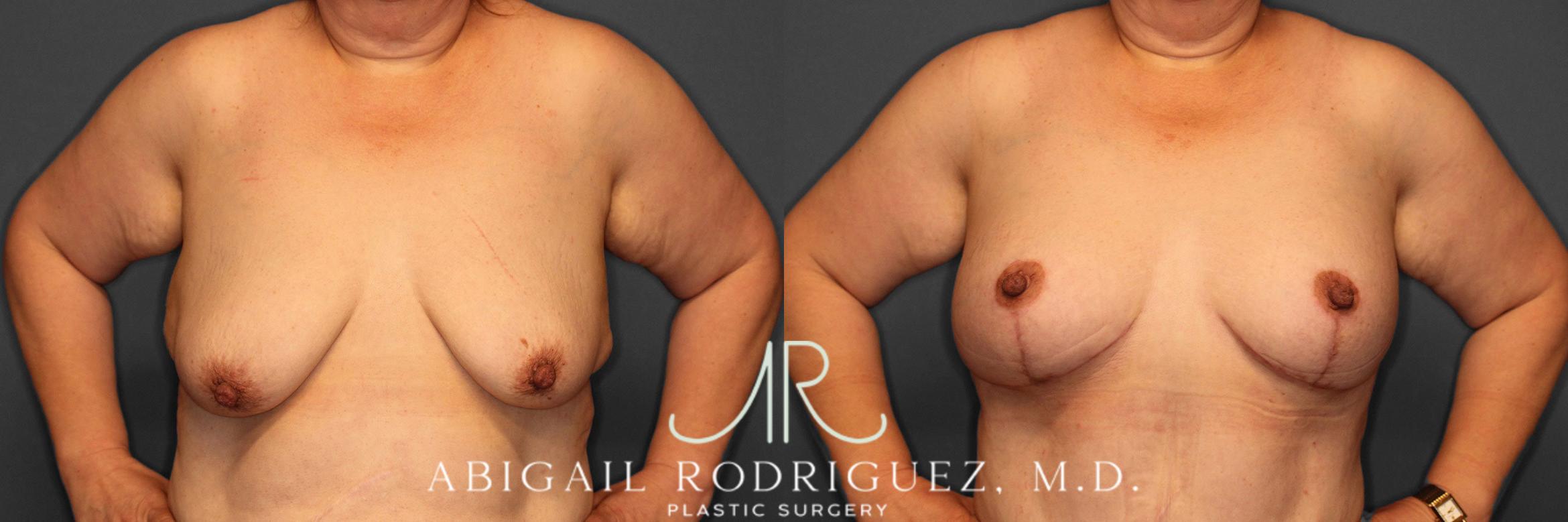 Before & After Breast Lift with Augmentation Case 258530 View 2 View in Houston, TX
