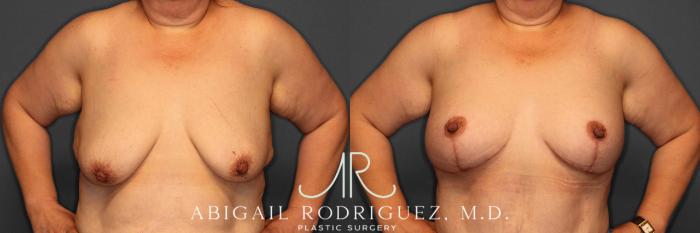 Before & After Breast Lift with Augmentation Case 258530 View 2 View in Houston, TX