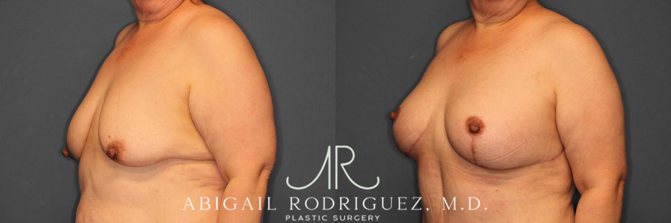 Before & After Breast Lift with Augmentation Case 258530 View 3 View in Houston, TX