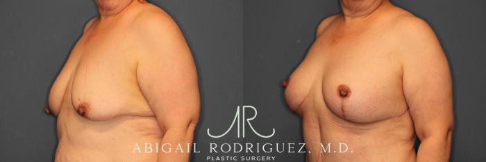 Before & After Breast Lift with Augmentation Case 258530 View 3 View in Houston, TX