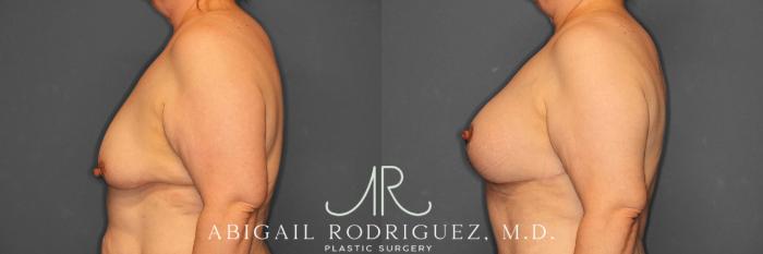 Before & After Breast Lift with Augmentation Case 258530 View 4 View in Houston, TX