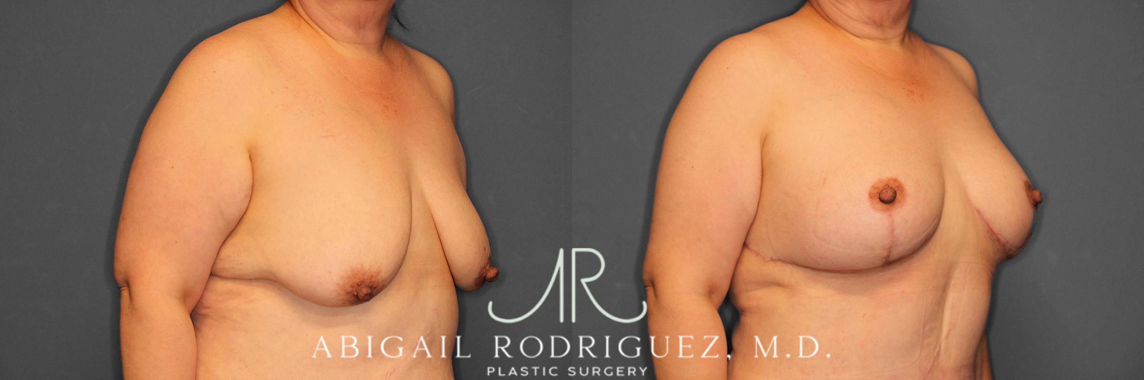 Before & After Breast Lift with Augmentation Case 258530 View 5 View in Houston, TX