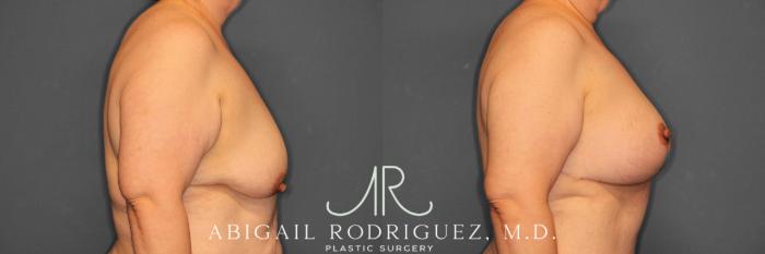 Before & After Breast Lift with Augmentation Case 258530 View 6 View in Houston, TX