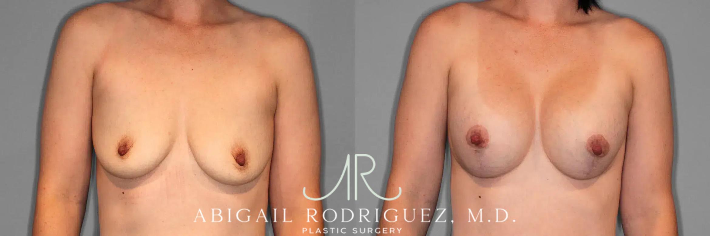 Before & After Breast Lift with Augmentation Case 259079 View 1 View in Houston, TX