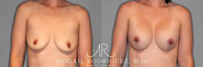 Before & After Breast Lift with Augmentation Case 259079 View 1 View in Houston, TX