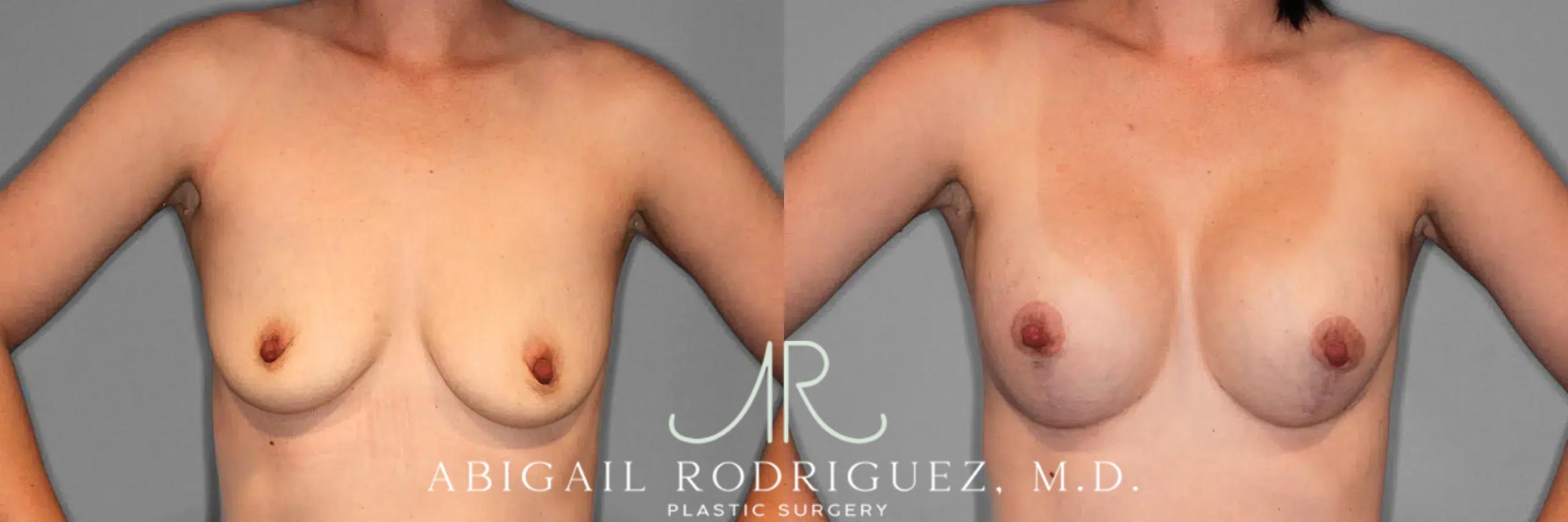 Before & After Breast Lift with Augmentation Case 259079 View 2 View in Houston, TX