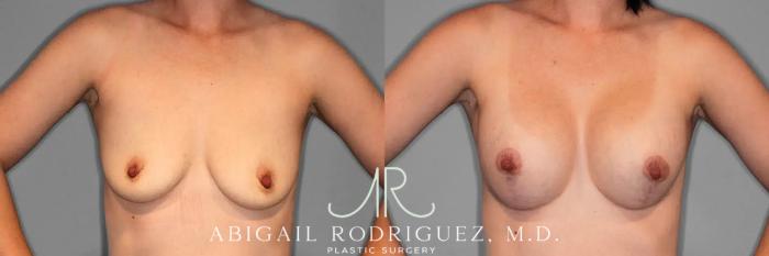 Before & After Breast Lift with Augmentation Case 259079 View 2 View in Houston, TX