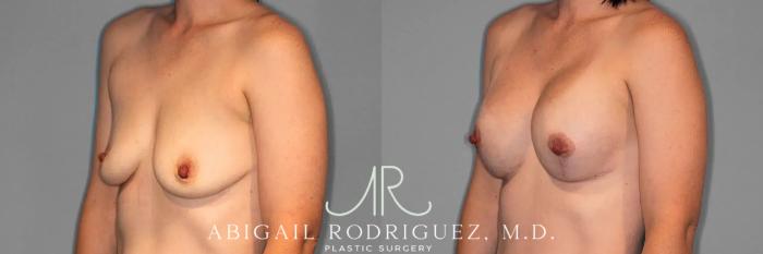 Before & After Breast Lift with Augmentation Case 259079 View 3 View in Houston, TX