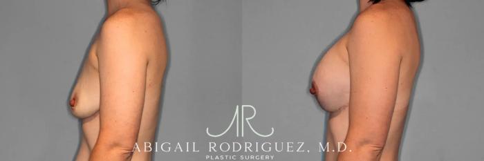 Before & After Breast Lift with Augmentation Case 259079 View 4 View in Houston, TX