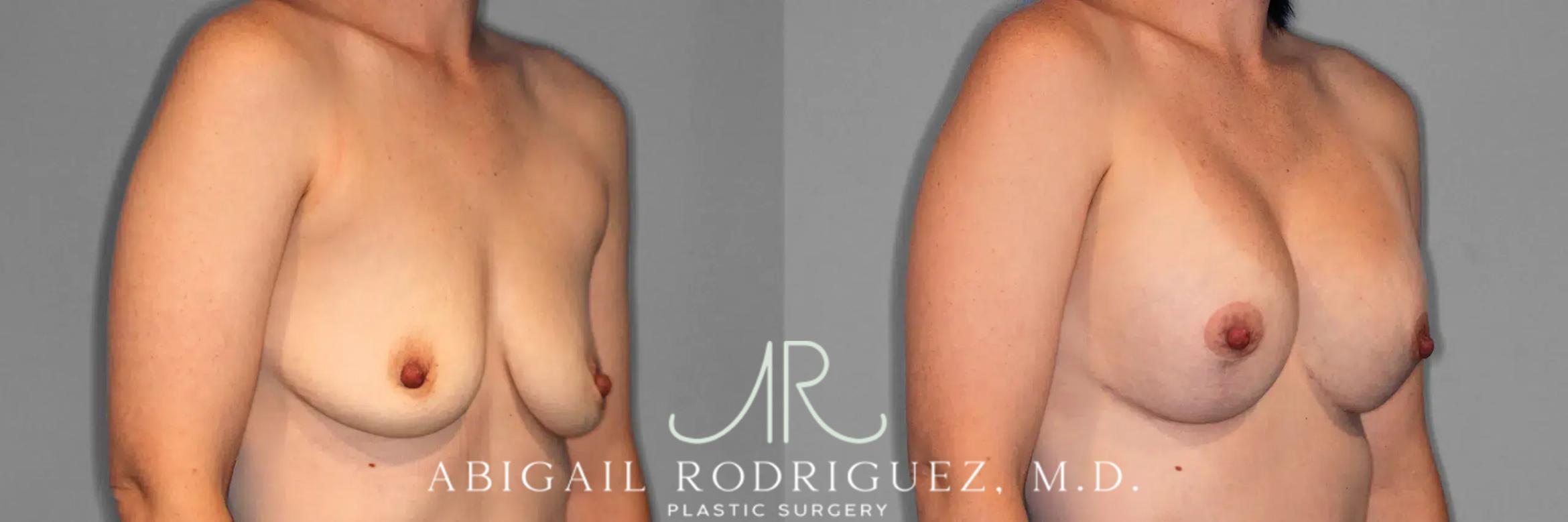 Before & After Breast Lift with Augmentation Case 259079 View 5 View in Houston, TX