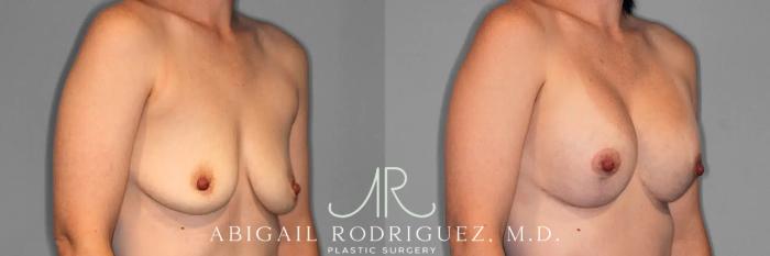 Before & After Breast Lift with Augmentation Case 259079 View 5 View in Houston, TX