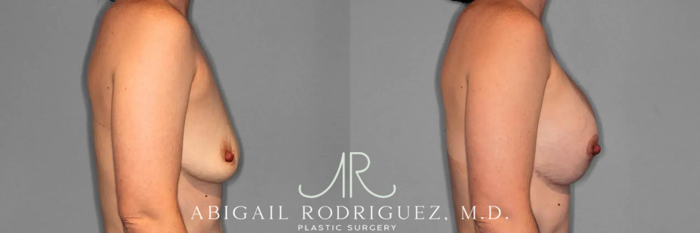 Before & After Breast Lift with Augmentation Case 259079 View 6 View in Houston, TX