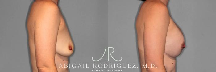 Before & After Breast Lift with Augmentation Case 259079 View 6 View in Houston, TX