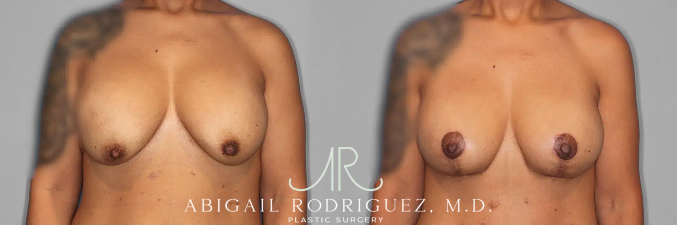 Before & After Breast Lift with Augmentation Case 259561 View 1 View in Houston, TX
