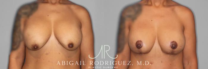 Before & After Breast Lift with Augmentation Case 259561 View 1 View in Houston, TX